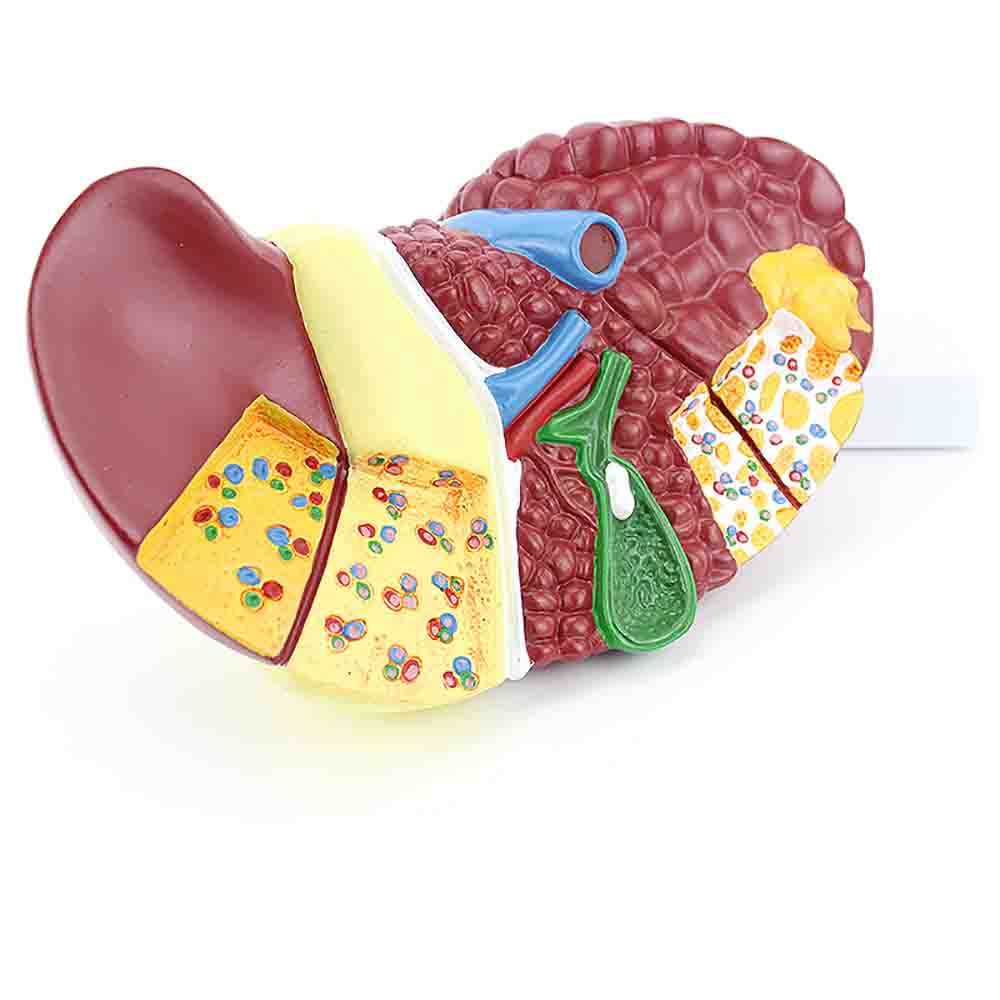 Liver with Pathologies Model