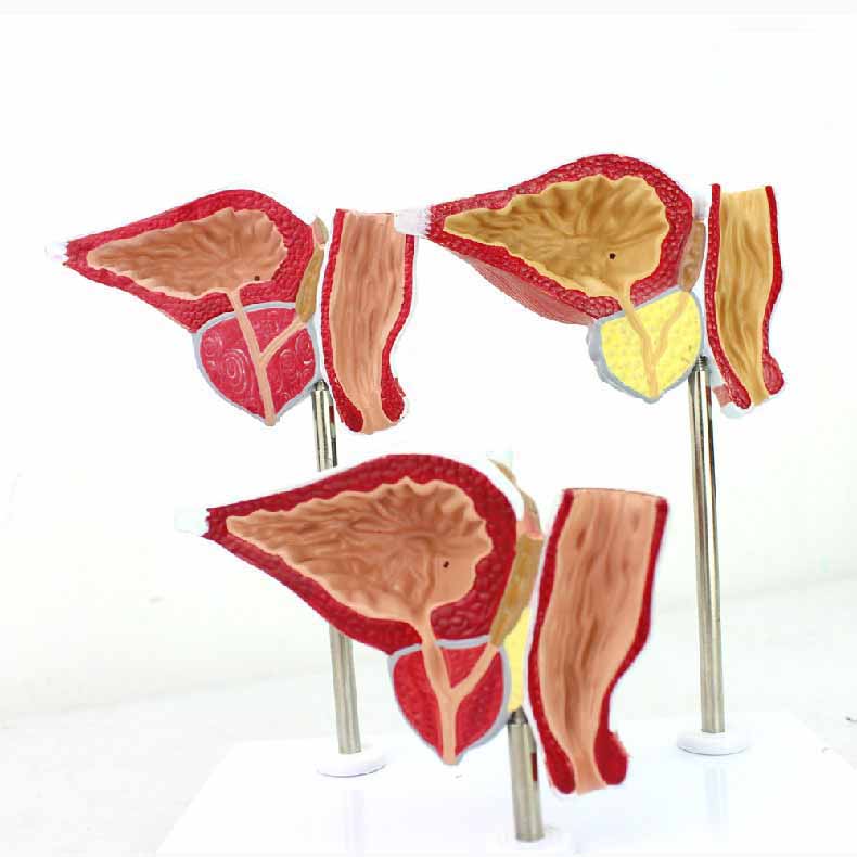 Normal and Diseased Prostate Gland Model – Dr Wong Anatomy