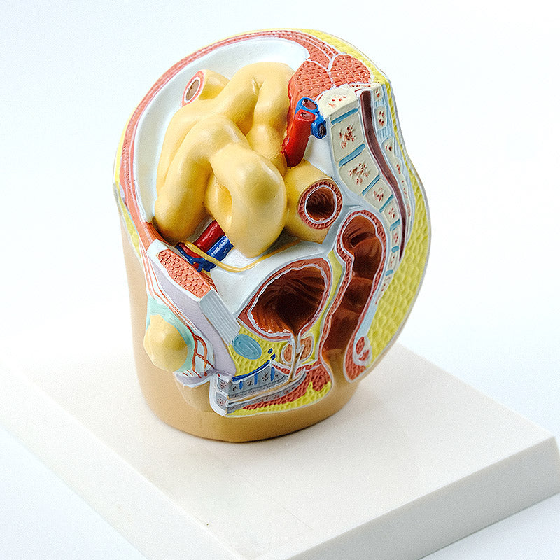 Indirect Inguinal Hernia Model