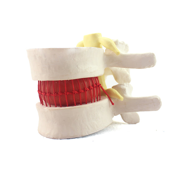 Vertebral Simulator with Herniated Disc