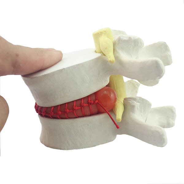 Vertebral Simulator with Herniated Disc