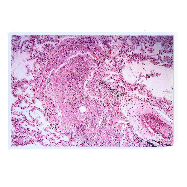 Human Lung Abscess, Microscope Slide - Dr Wong Anatomy