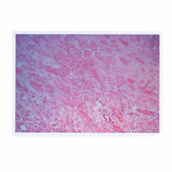 Kidney Coagulative Necrosis, Microscope Slide - Dr Wong Anatomy