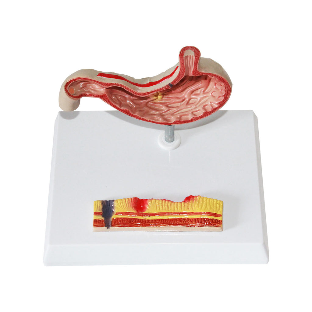 Stomach with Ulcers Model, Life-Size - Dr Wong Anatomy