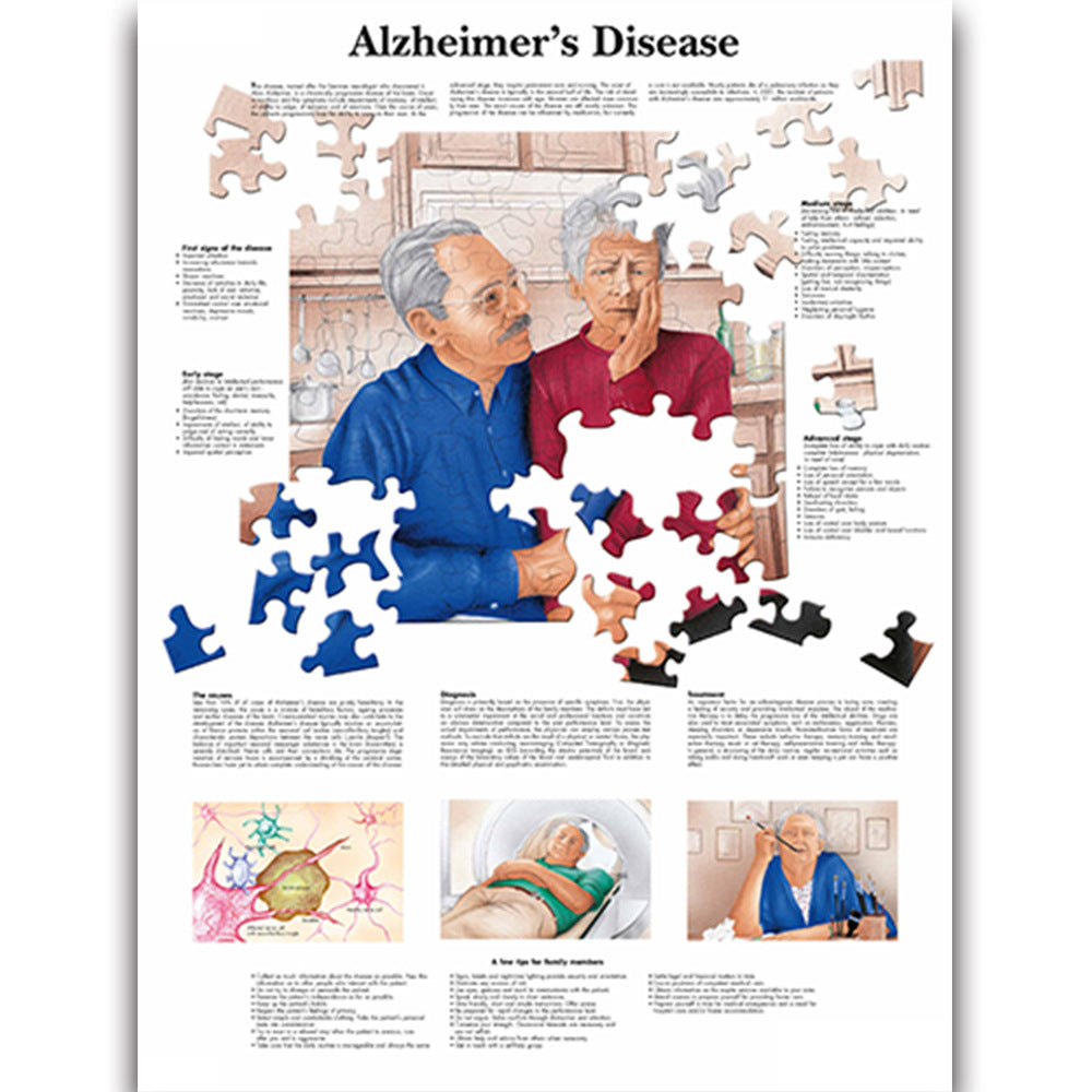 Alzheimer's Disease Chart - Dr Wong Anatomy