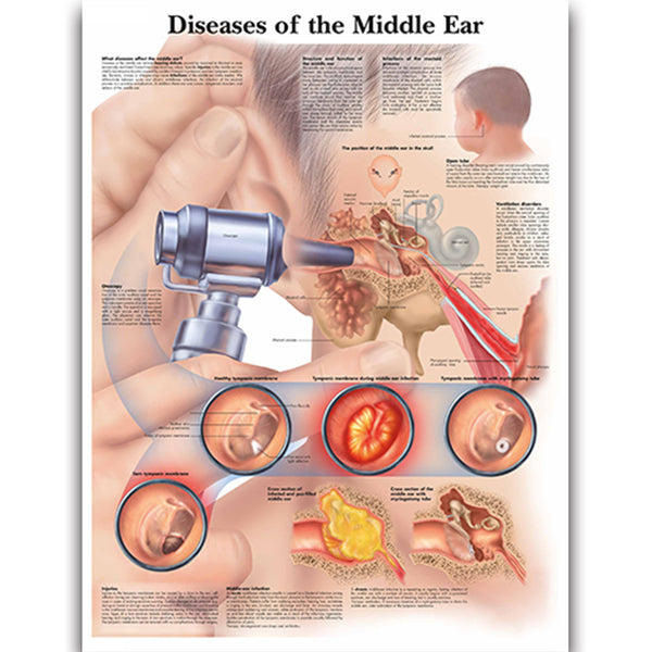 Diseases of the Middle Ear Chart - Dr Wong Anatomy