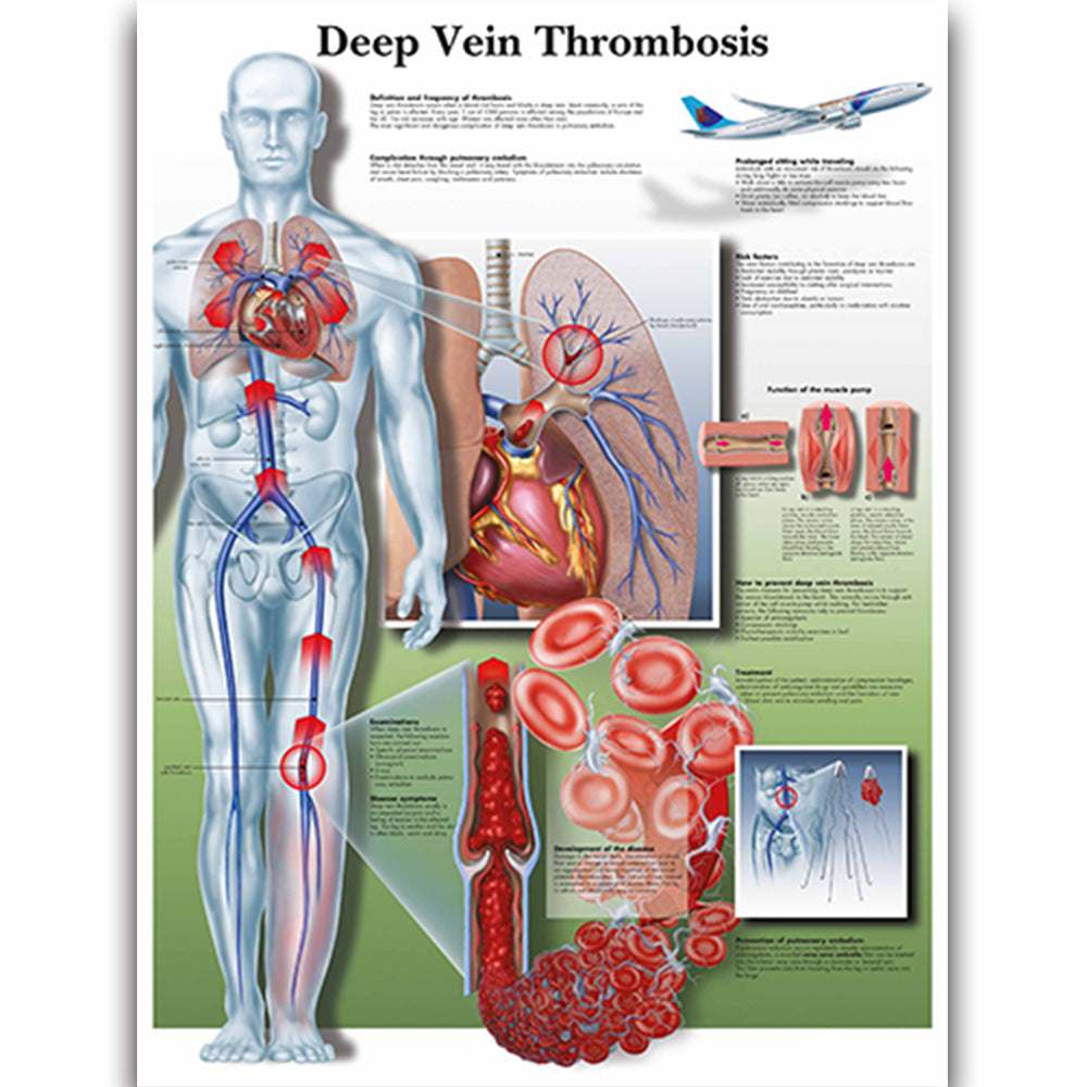 Deep Vein Thrombosis disease Chart - Dr Wong Anatomy
