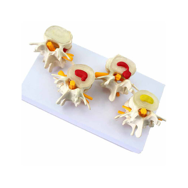 Degenerative Lumbar Vertebrae Disk Disease - Dr Wong Anatomy