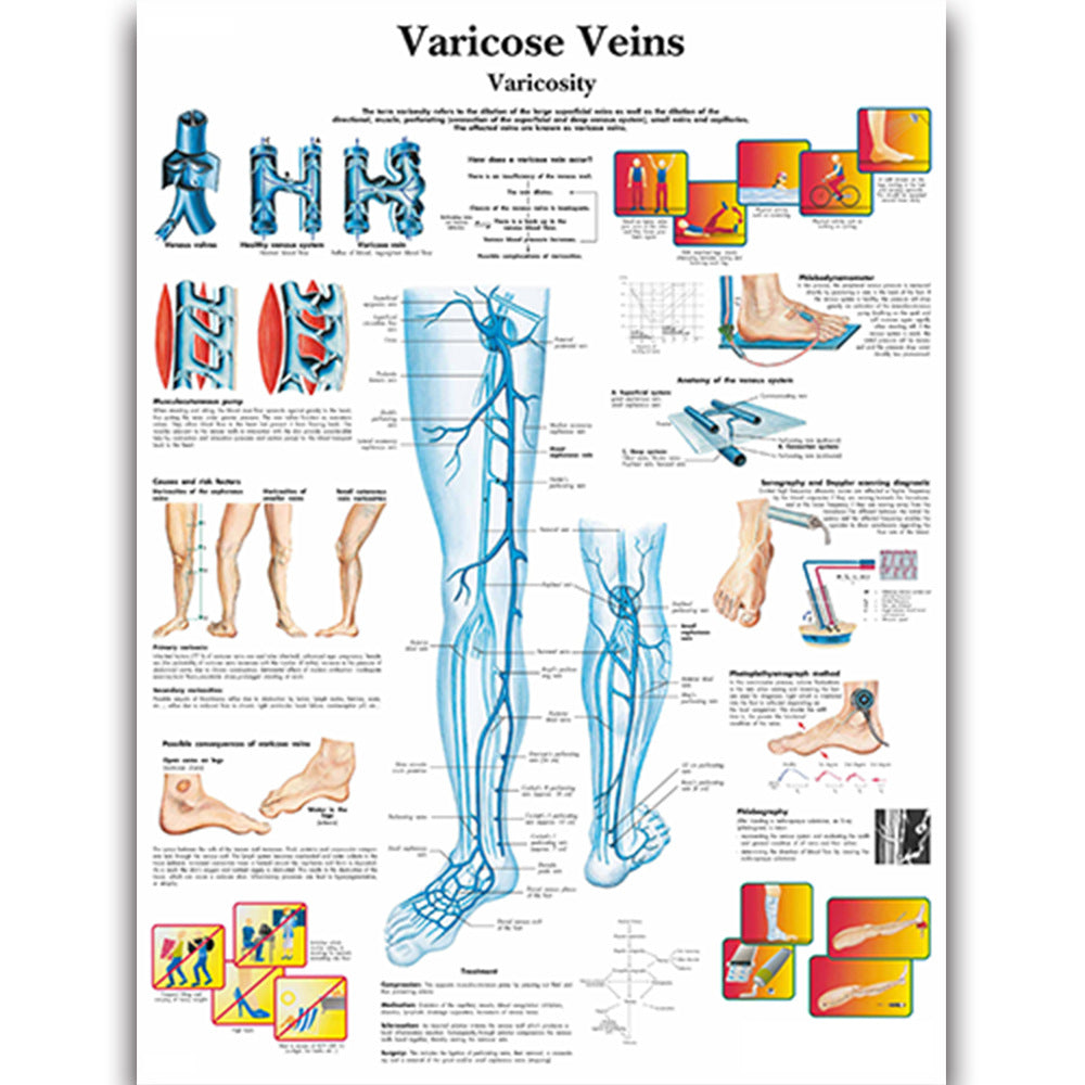 Varicose Veins Chart - Dr Wong Anatomy