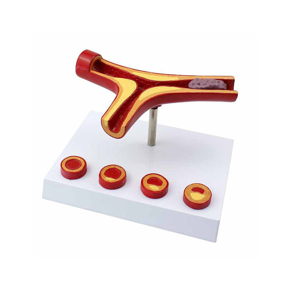 Arteriosclerosis Model, 4 Stages - Dr Wong Anatomy