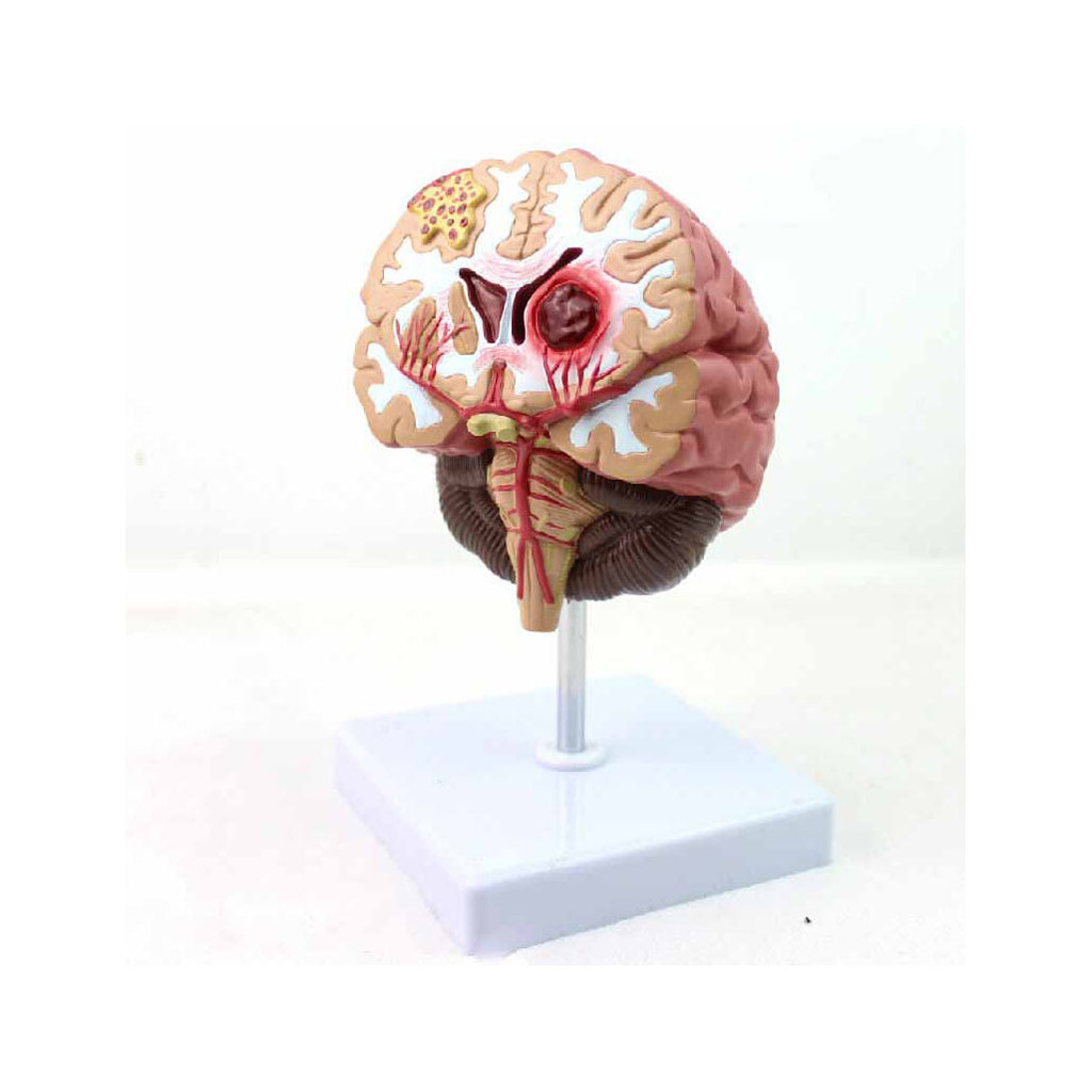 Brain Pathologies Model, Life-Size - Dr Wong Anatomy