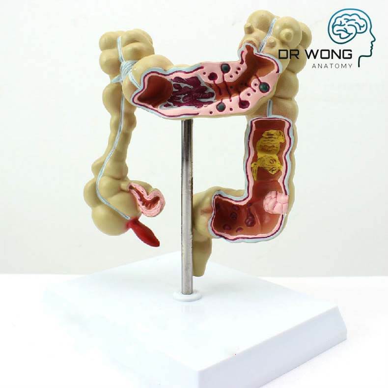 Colon Model with Pathologies – Dr Wong Anatomy