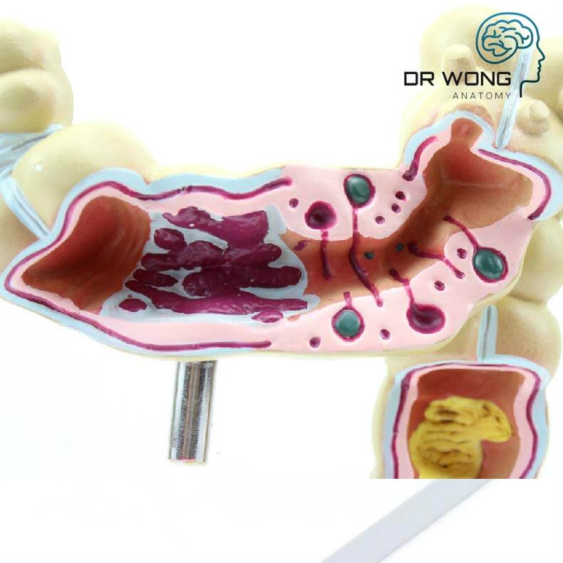 Colon Model with Pathologies – Dr Wong Anatomy