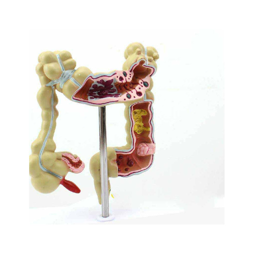 Colon Model with Pathologies – Dr Wong Anatomy