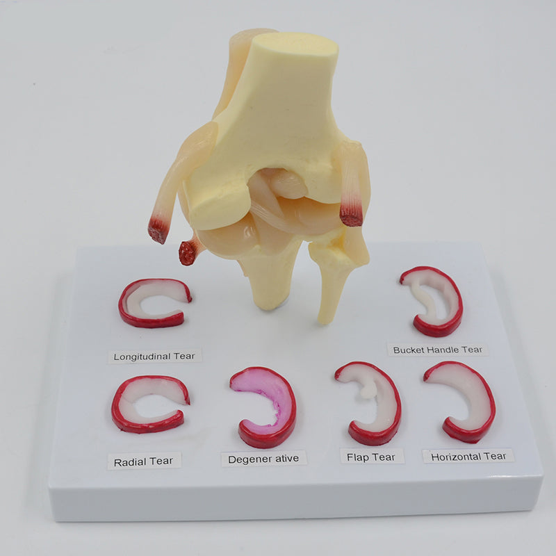 Meniscus Modeled Knee Model with Meniscus Tears