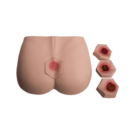 4-Stages Pressure Ulcer/Bedsore Model - Dr Wong Anatomy