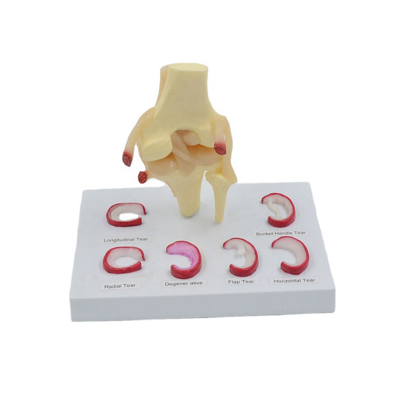 Knee Model with Meniscus Tears