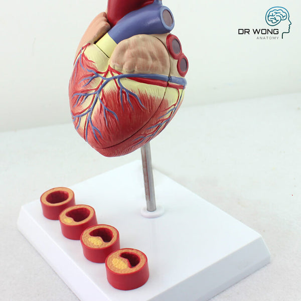 Heart Model with Artery Disease Display
