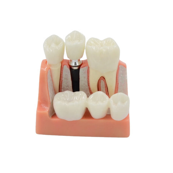 Dental Implant Model, 2.5X Life-Size