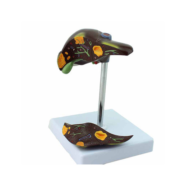 Liver Diseases Model，1/3 Life-Size, 2 Parts - Dr Wong Anatomy