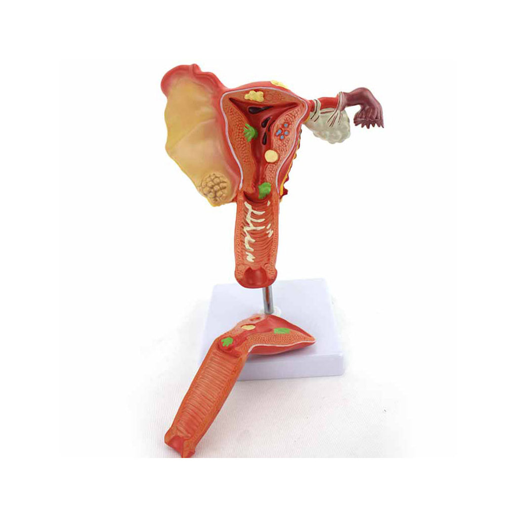 Pathological Model of the Female Genital Organs