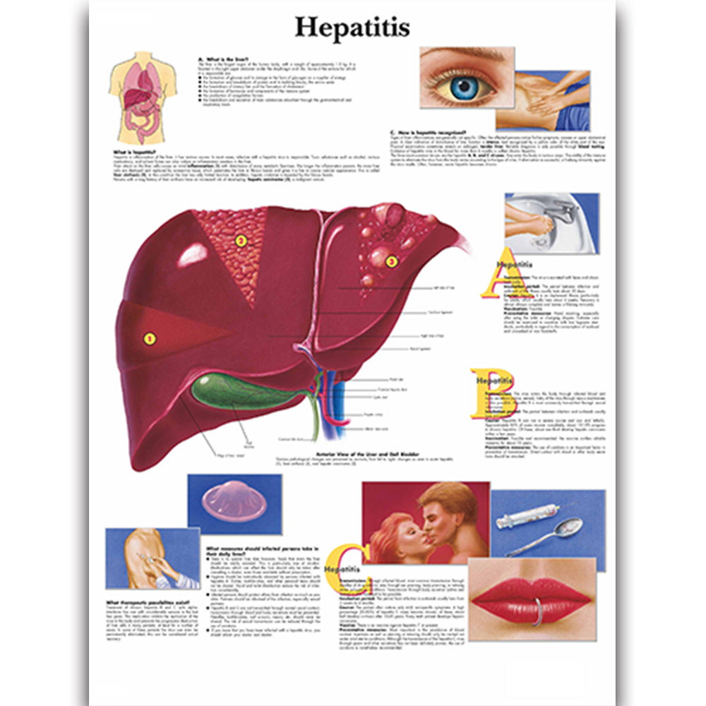 Hepatitis disease Chart - Dr Wong Anatomy