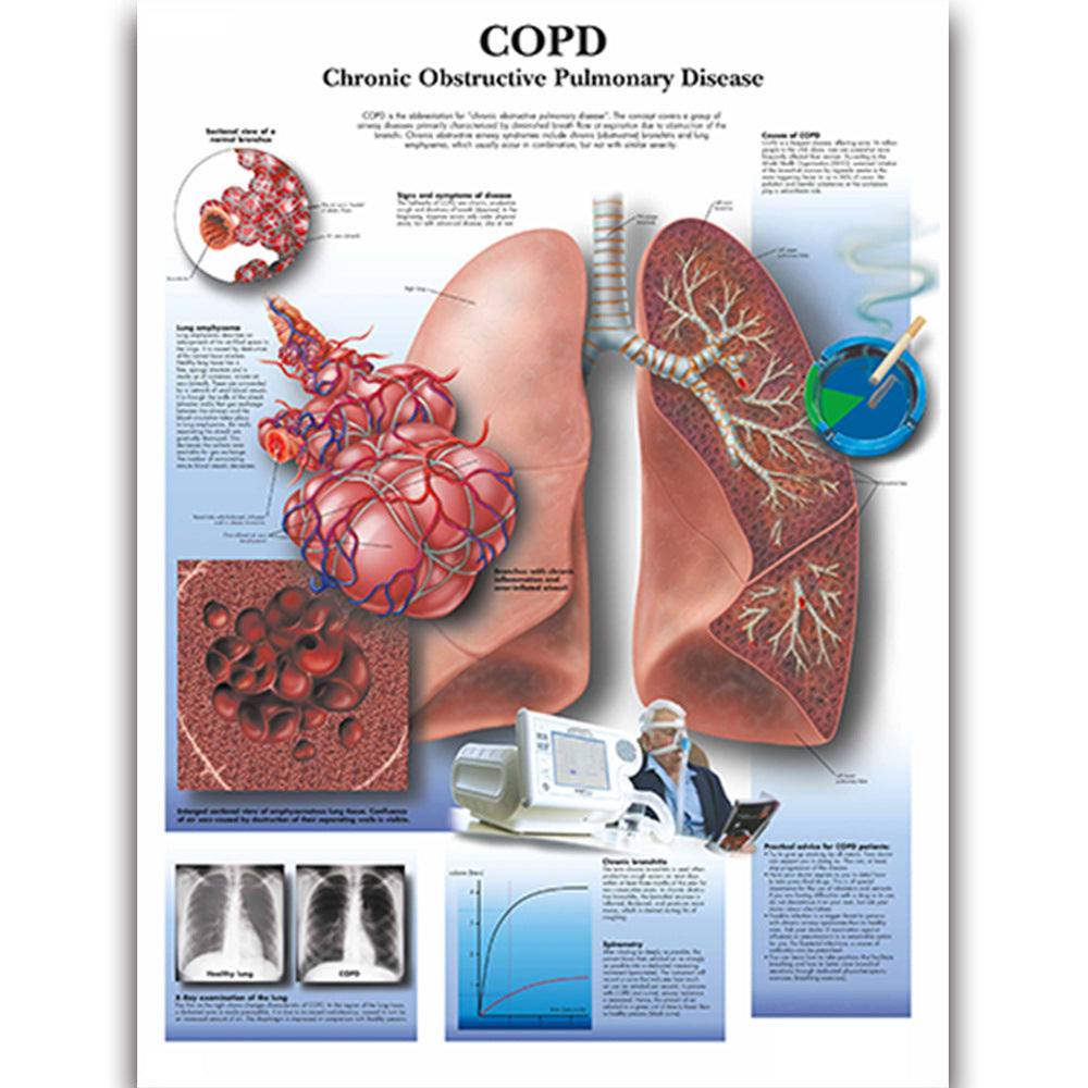 COPD Disease Chart - Dr Wong Anatomy