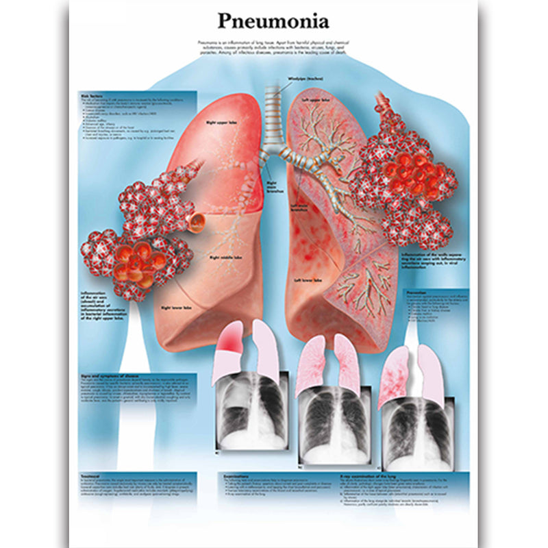 Health Education Chart - Pneumonia