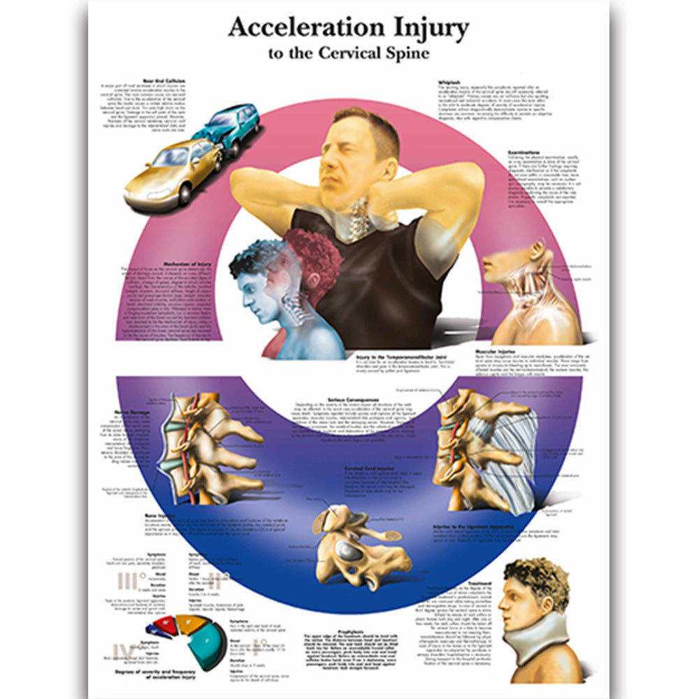 Health Education Chart - Acceleration Injury – Dr Wong Anatomy
