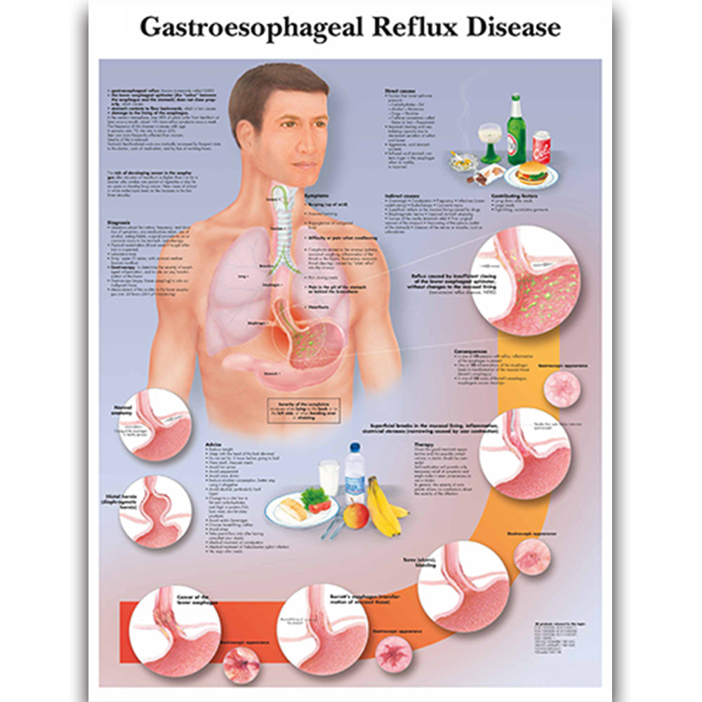 Health Education Chart - Gastroesophageal Reflux Disease