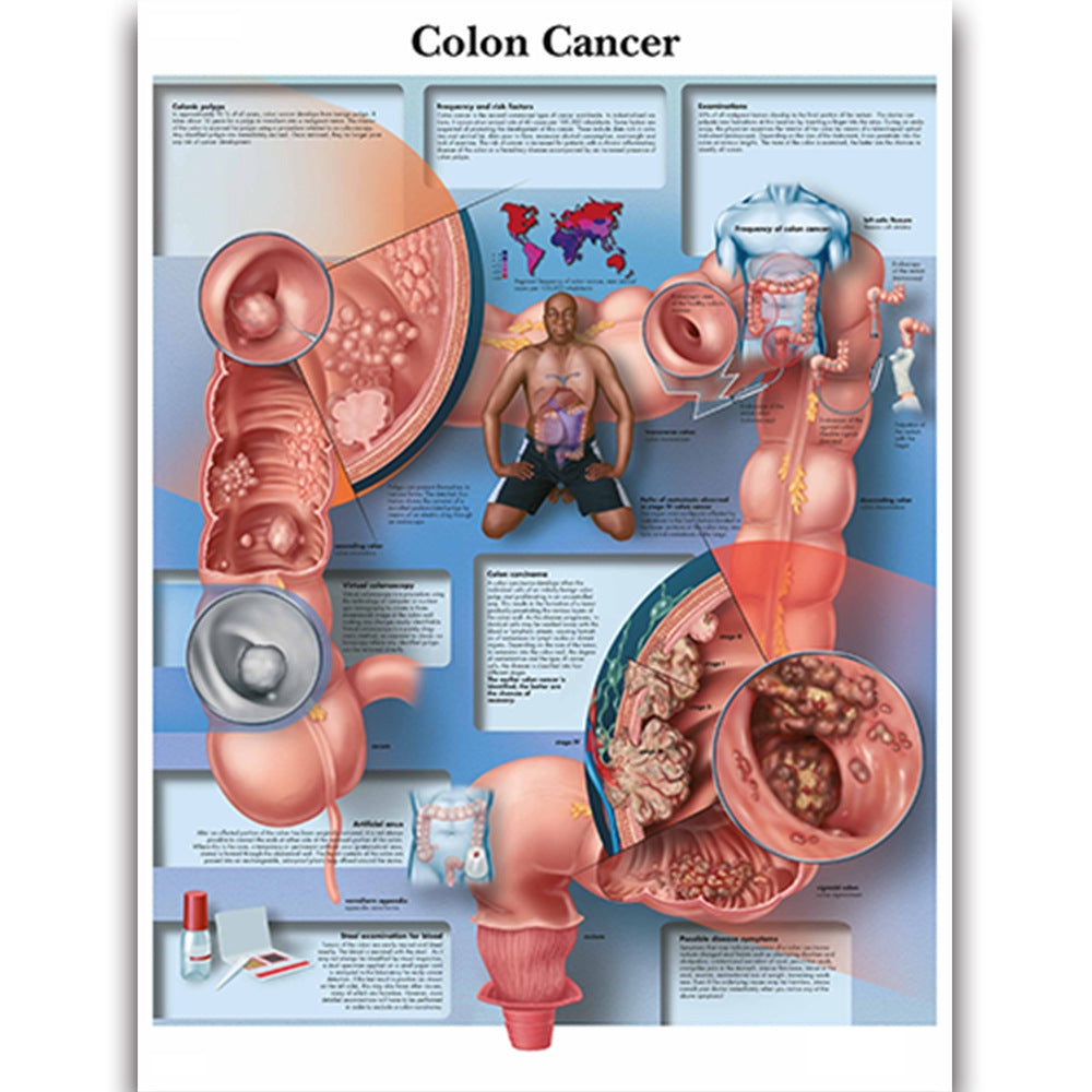 Colon Cancer disease chart - Dr Wong Anatomy