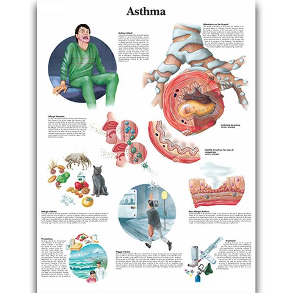 Asthma Chart - Dr Wong Anatomy
