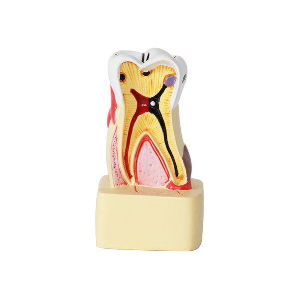 Dental Pathology Model, 4X Life-Size