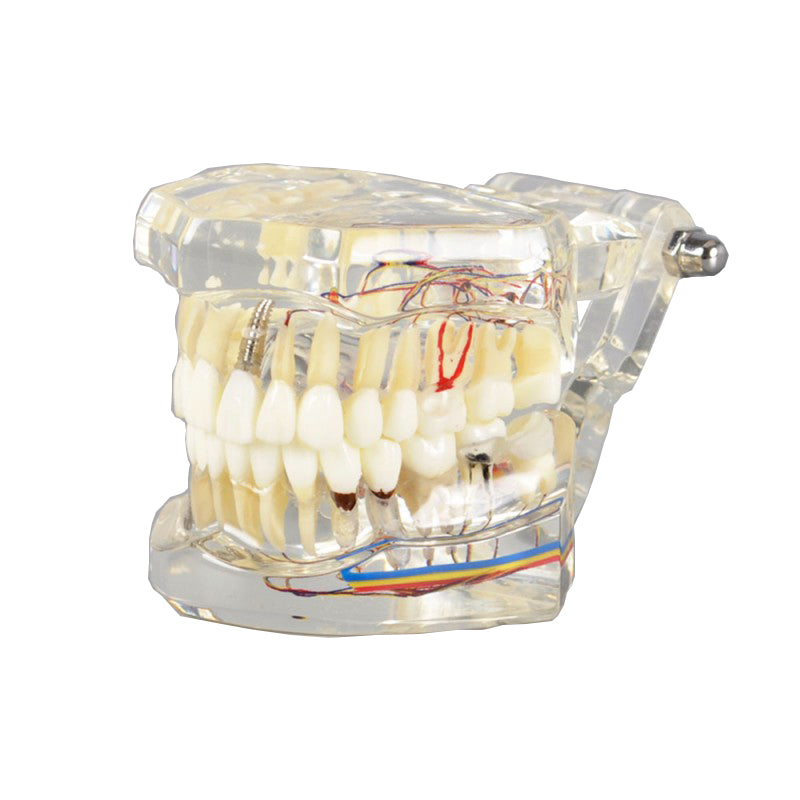 Implant Tooth and Restoration Model with Nerve