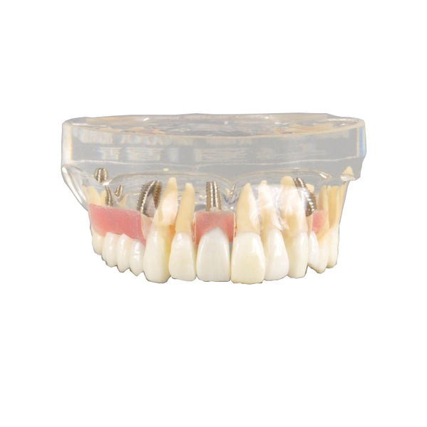 Dental Implant Model with Soft Gingiva and Bridge
