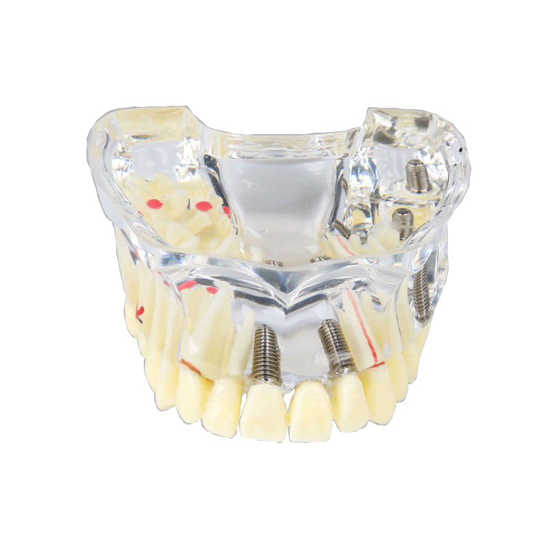 Dental Implant Model for Demonstration