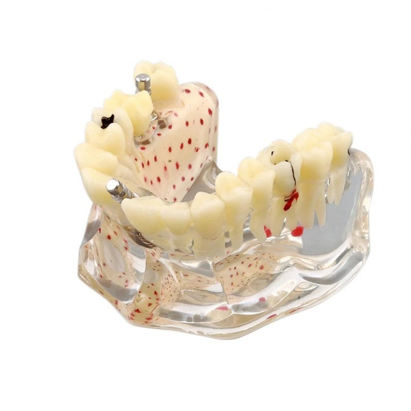 Dental Implant Model with Caries and Root Fracture