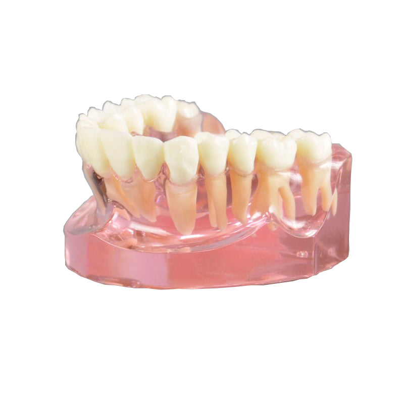 W2008 Dental Implant Model with Ceramic Bridge Implant Bridge