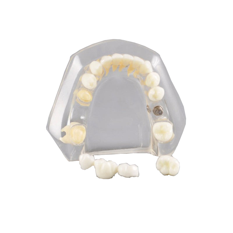  Dental Implant Model Mandibular with Natural Color Teeth