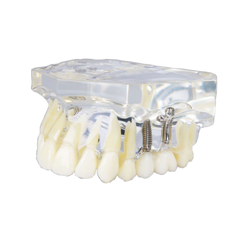  Dental Implant Model Maxillary Model with Crown and Implant