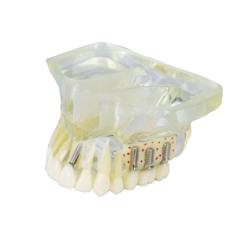 Dental Implant Model Upper Jaw Model Restoration Model