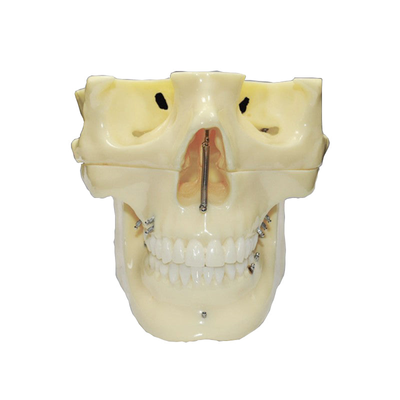 Dental Orthodontic Implant Model