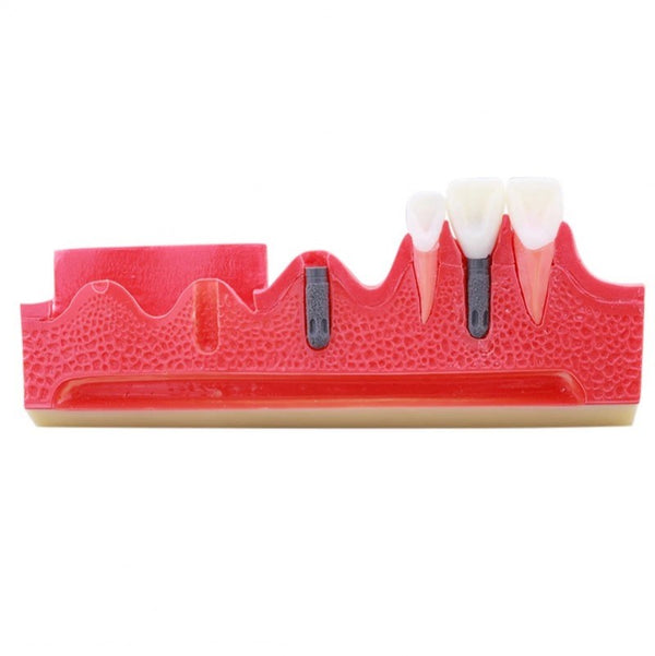 Steps for Implant Demonstration Model