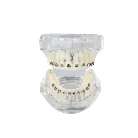Dental Orthodontic Model with Metal Bracket for Demonstration