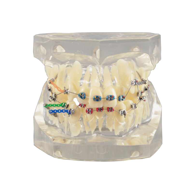 Dental Orthodontic Model with Metal Bracket for Demonstration