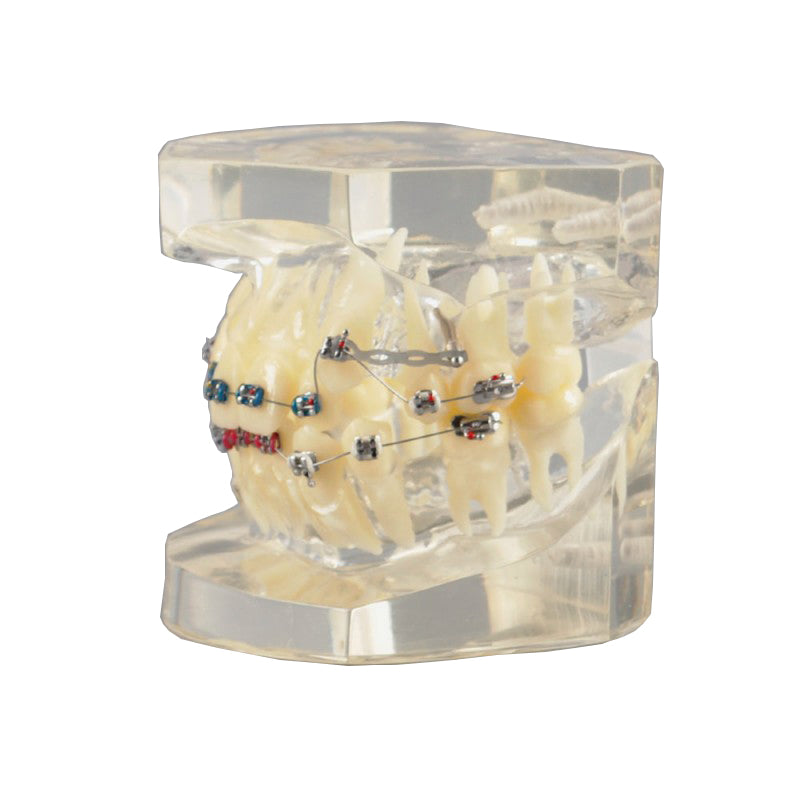 W3005-3 Dental Orthodontic Model with Metal Bracket for Demonstration ...
