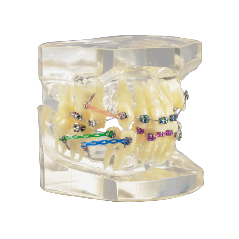 W3005-3 Dental Orthodontic Model with Metal Bracket for Demonstration ...