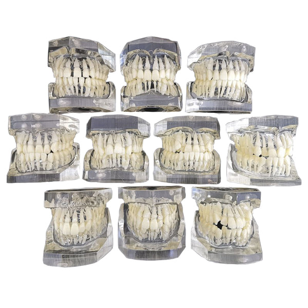 Dental Malocclusion Model for Demonstration