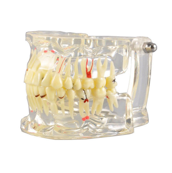 Adult Dental Pathology Model with Different Symptom