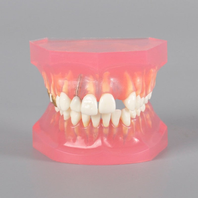 Dental Model with Caries Treatment and Other Cases
